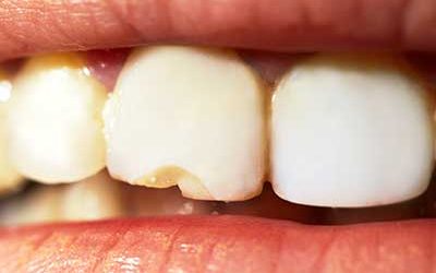 An einem Zahn sind Teile abgebrochen