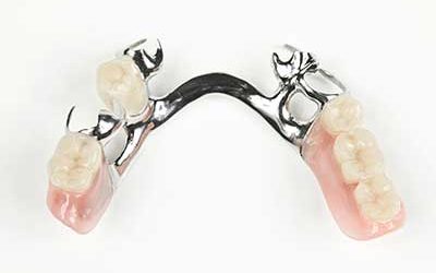 Hilfe bei geschädigten und fehlenden Zähnen
